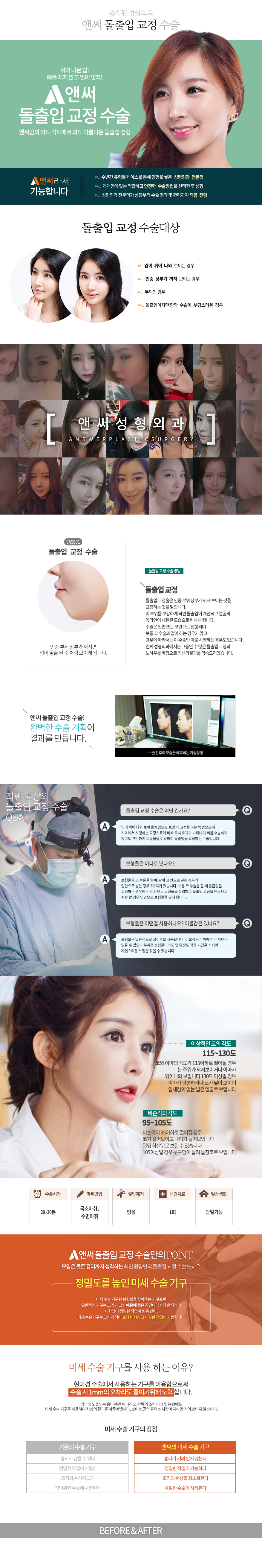 돌출입 교정술