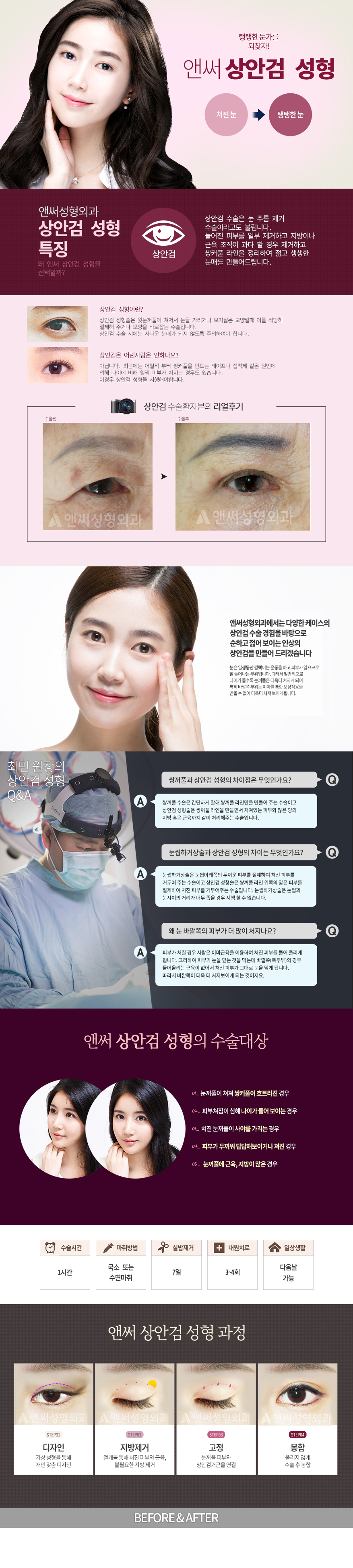 상안검 성형술